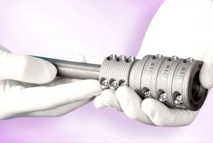 OsteoBridge™ IntraDocking™ Implantat zur Versorgung einer periprothetischen Femurfraktur